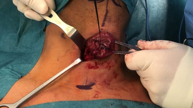 Thyroid Surgery In Alzahra Thyroid Center One Day Surgery Discharge Home Same Day No Drain Small Incision We Are Proud Of It Sadir Alrawi & Team Dubai UAE June 2018