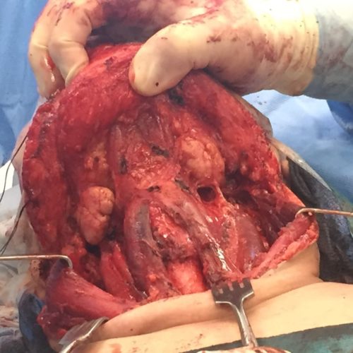 Total Radical Thyroidectomy With Bilateral Neck Dissections For Metastatic Papillary Cancer In Alzahra Cancer Center, January 2018.