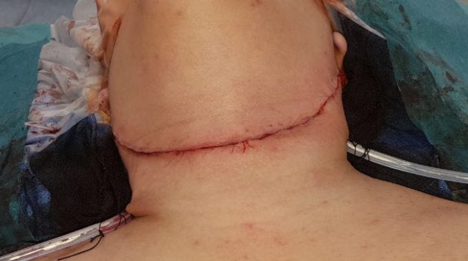 Total Radical Thyroidectomy With Bilateral Neck Dissections For Metastatic Papillary Cancer In Alzahra Cancer Center, January 2018.