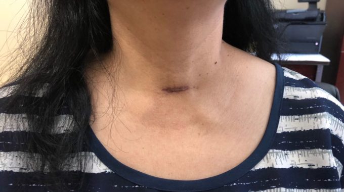 Thyroid Surgery For Total Radical Thyroidectomy With Central Node Dissection In Alzahra Thyroid Center, June 2018