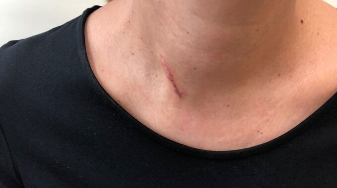 Parathyroid Surgery In Alzahra Thyroid Center, By Sadir Alrawi, ER Ate Proud To Be There For You, Dubai UAE, Sadir Alrawi & Team