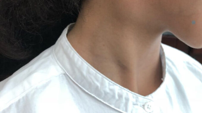 Branchial Cyst In 7 Year Old Girl From Alzahra Thyroid Center Sadir Alrawi & Team Dubai UAE August 2018