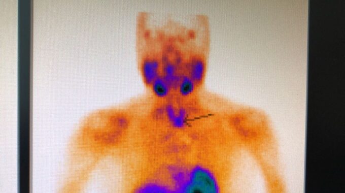 Parathyroid Localization In Alzahra Thyroid Center 10 Min Procedure For Minimal Invasive Parathyroidectomy We Are Proud To Be In That Center Sadir Alrawi & Team Dubai UAE August 2018