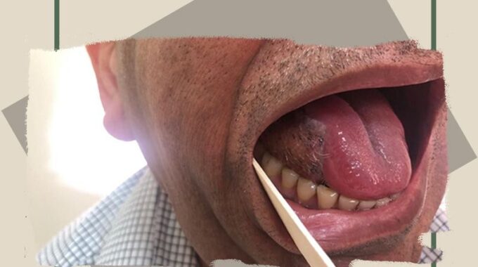 A Case Of Tongue Cancer, Operated In Alzahra Cancer Center With Tongue Excision And Reconstruction Surgery.