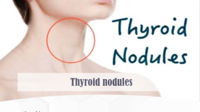Thyroid Nodule