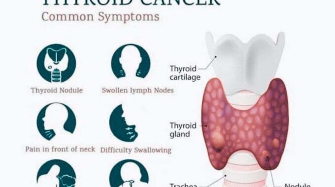 Thyroid Cancer