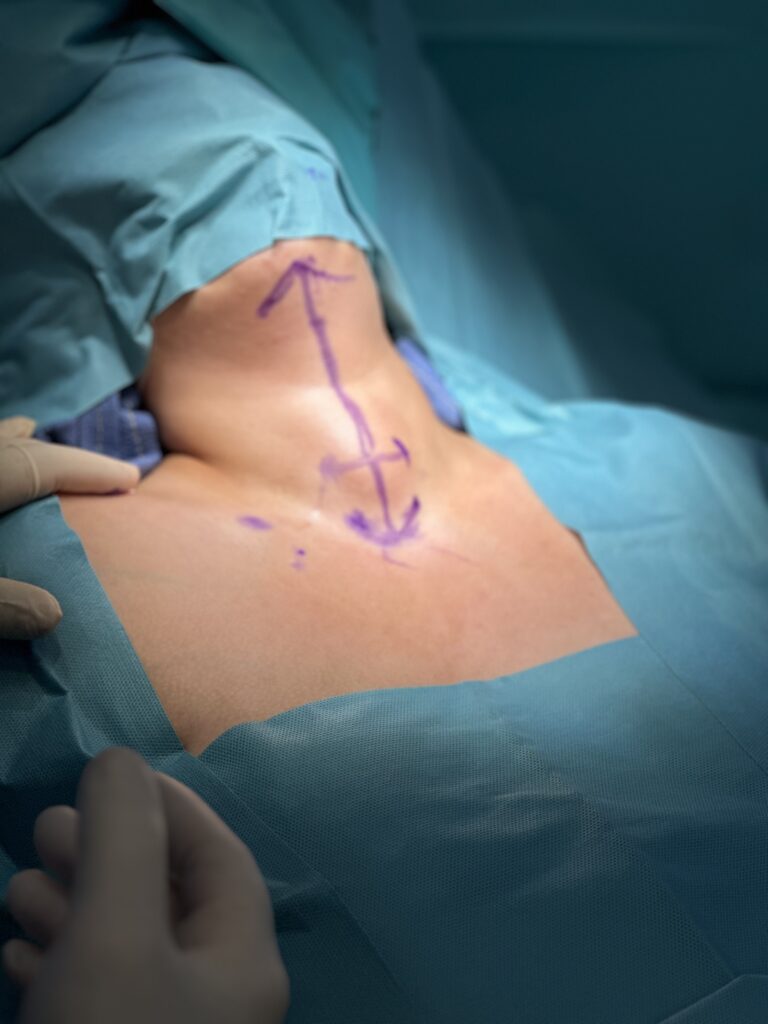 Minimal Invasive Thyroid Surgery